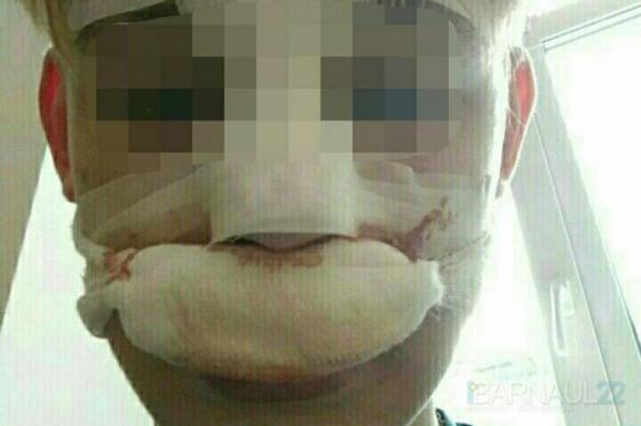 Парню, который снимал избиение школьницы на видео, сломали нос